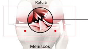 Piekło kontuzji więzadła krzyżowego